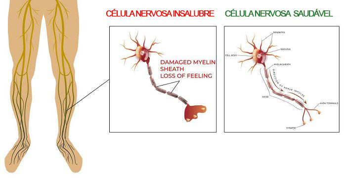 como prevenir e tratar a neuropatia